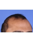 Before Hair Transplant&nbsp;2 Sessions (Areas)